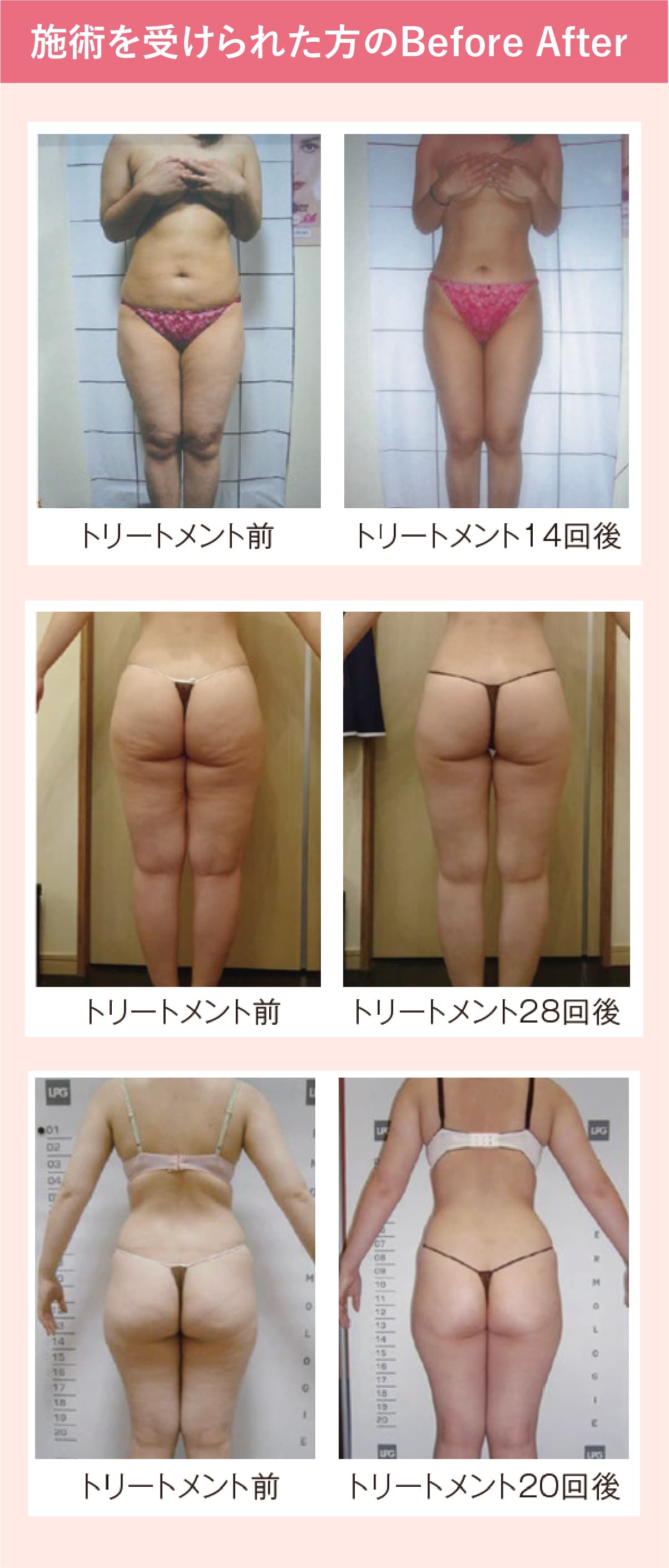 アミーダグレーシズのボディメニューBeforeAfter